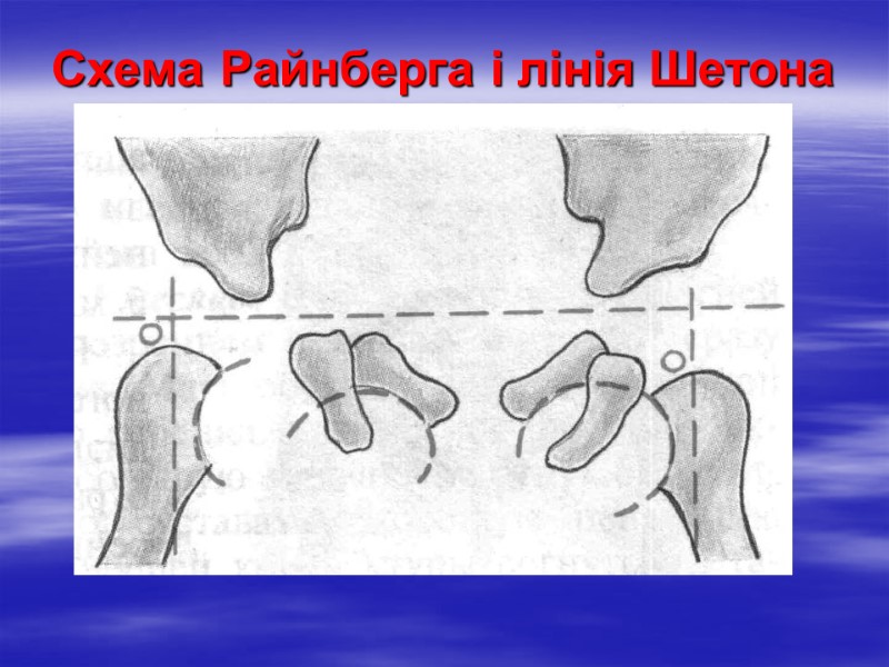 Схема Райнберга і лінія Шетона